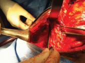 Graphical Abstract of Early abdominal closure using component separation in patients with an open abdomen after trauma: a pilot study